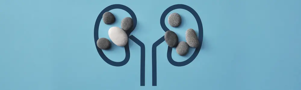 Kidney Stones: Small Crystals, Big Discomfort